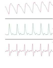 Accelerated Photoplethysmograph