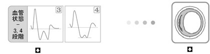 血管状態-3,4段階