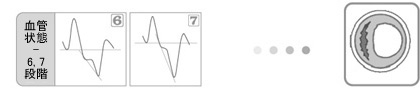 血管状態-6,7段階