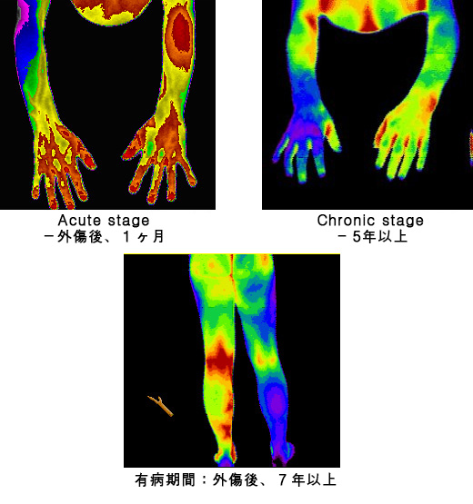 診断名 ： 複合性局所疼痛症候群 / CRPS multiple Case