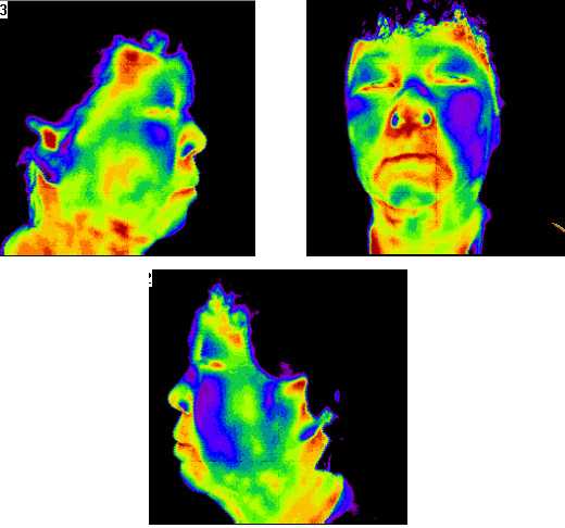 診断名 ： 顔面麻痺(Facial palsy)