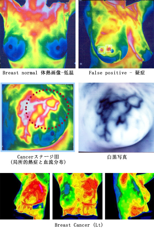 診断名 ： 乳癌(Breast Cancer)